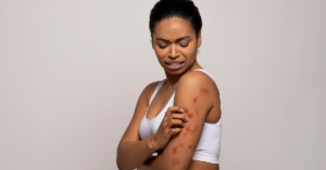 African woman with red rash on arm.