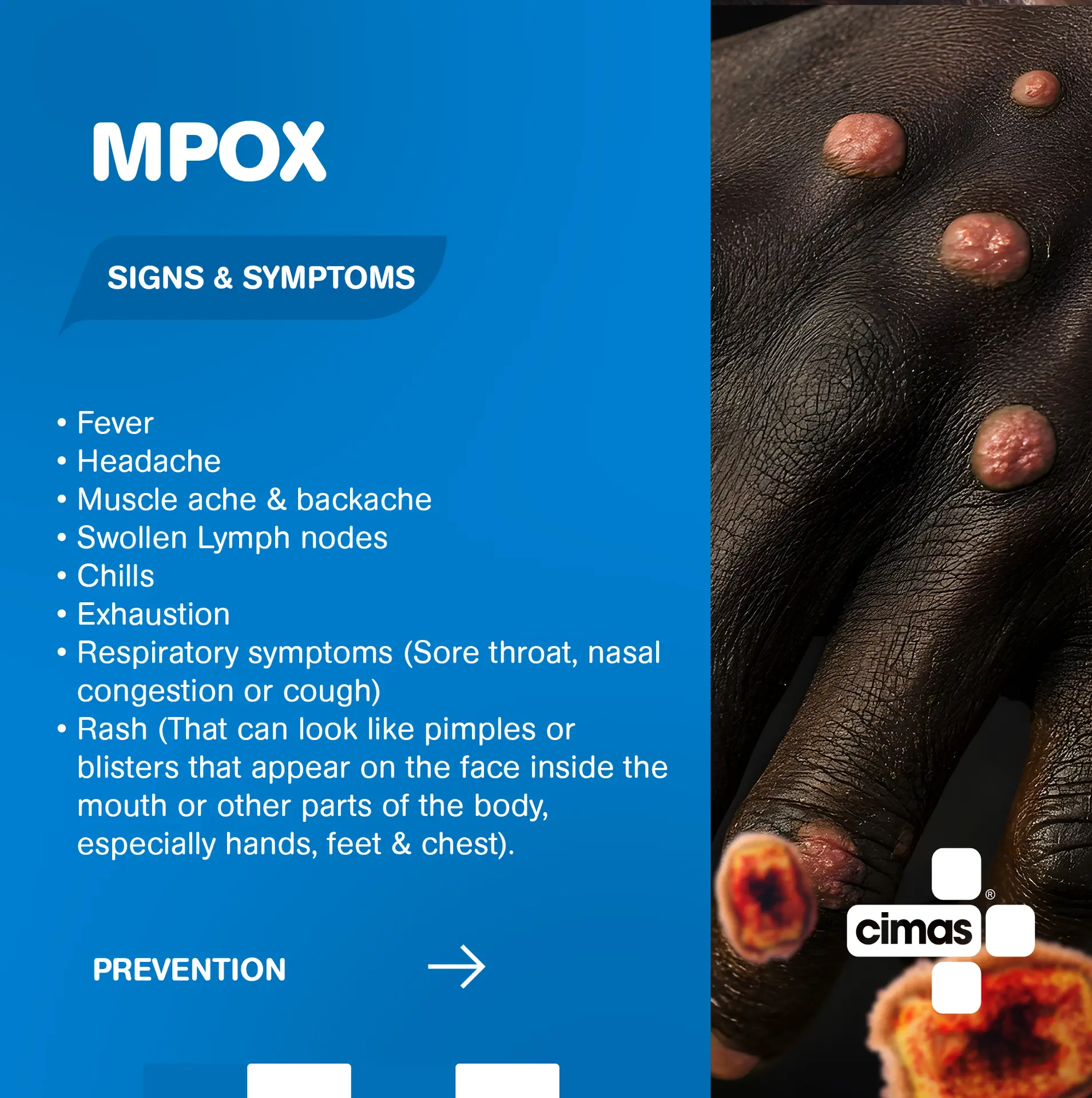 Mpox Signs and Symptoms