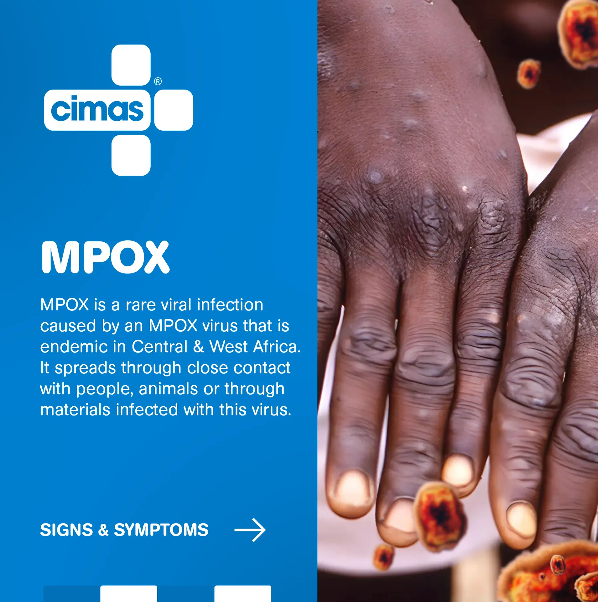 What is Mpox